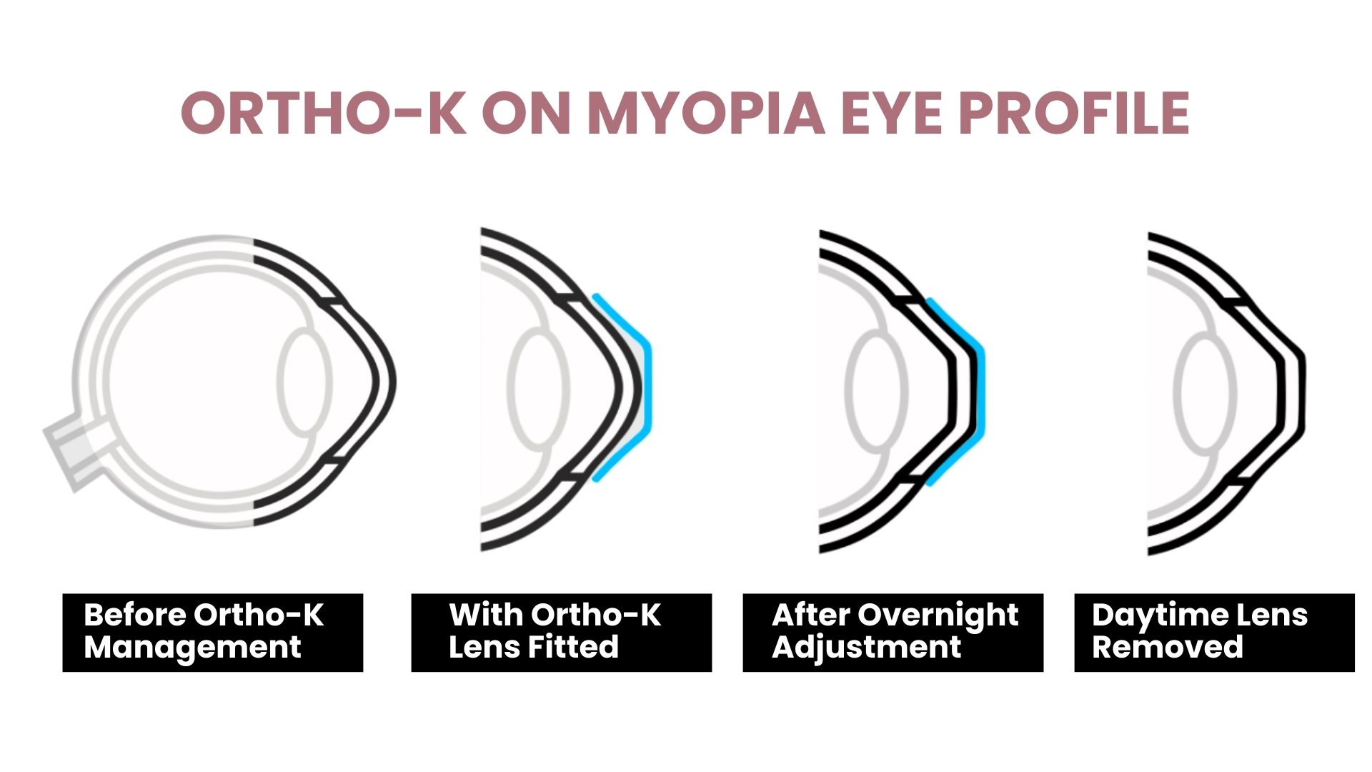 Ortho K Management Family Eye Center